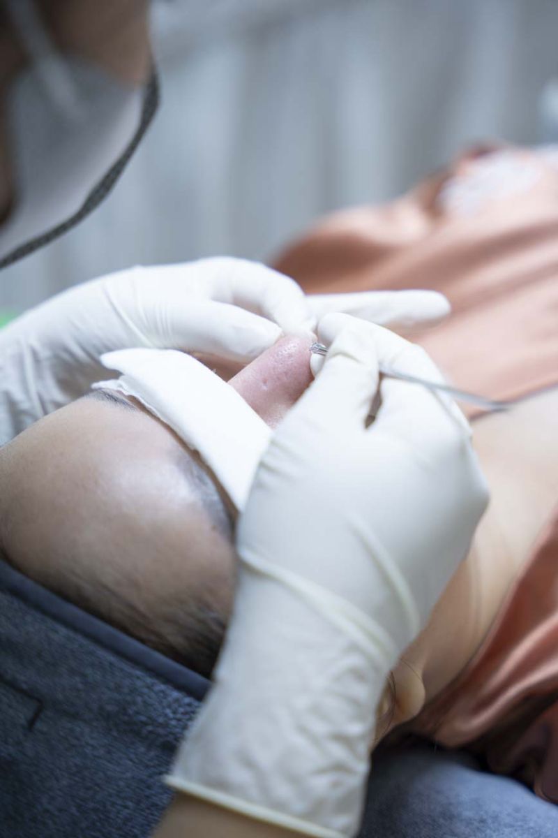 Địa chỉ lấy nhân mụn không sưng Bình Tân